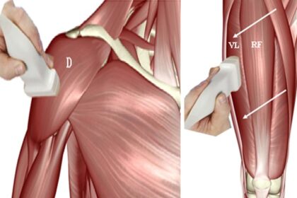 alt="Muscle ultrasound may detect early prediabetes"
