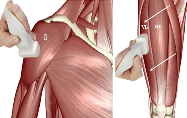 alt="Muscle ultrasound may detect early prediabetes"
